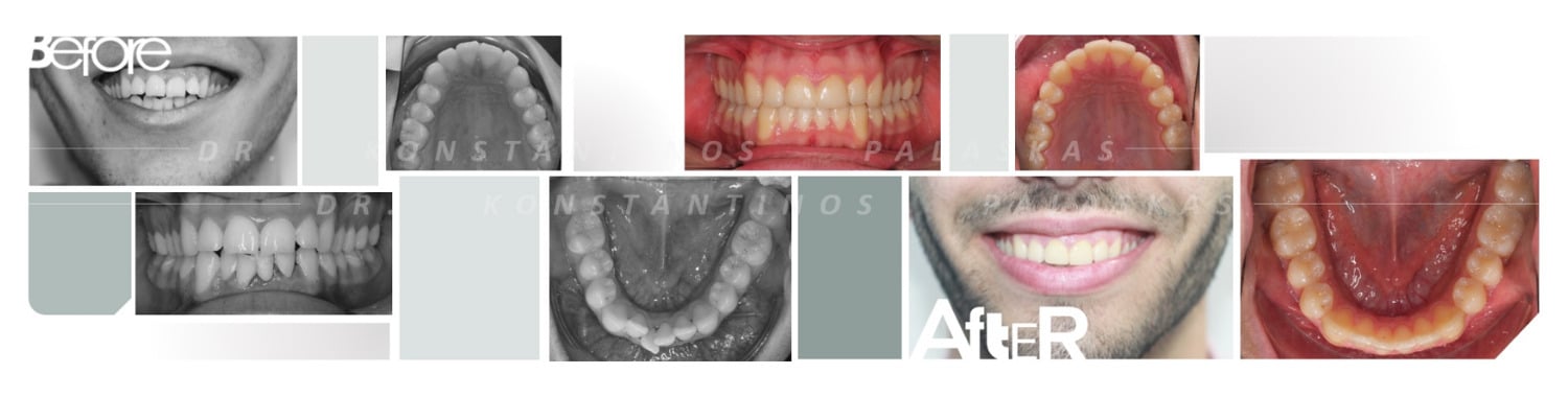 1 Apiñamiento Dental 0