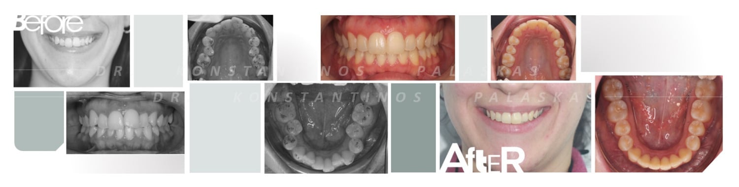 2 Apiñamiento Dental 0