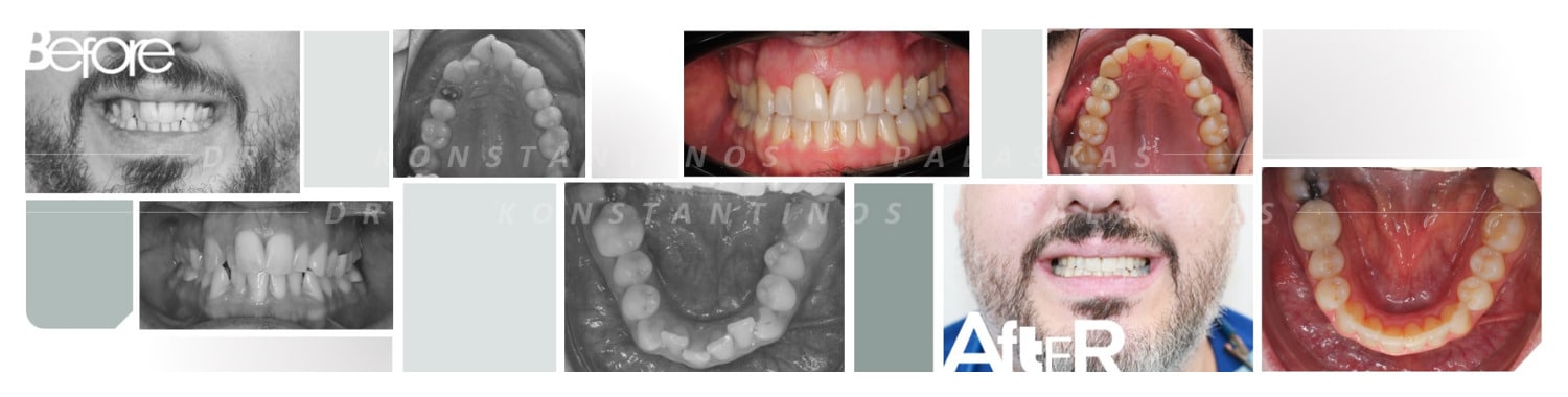 3 Apiñamiento Dental 0