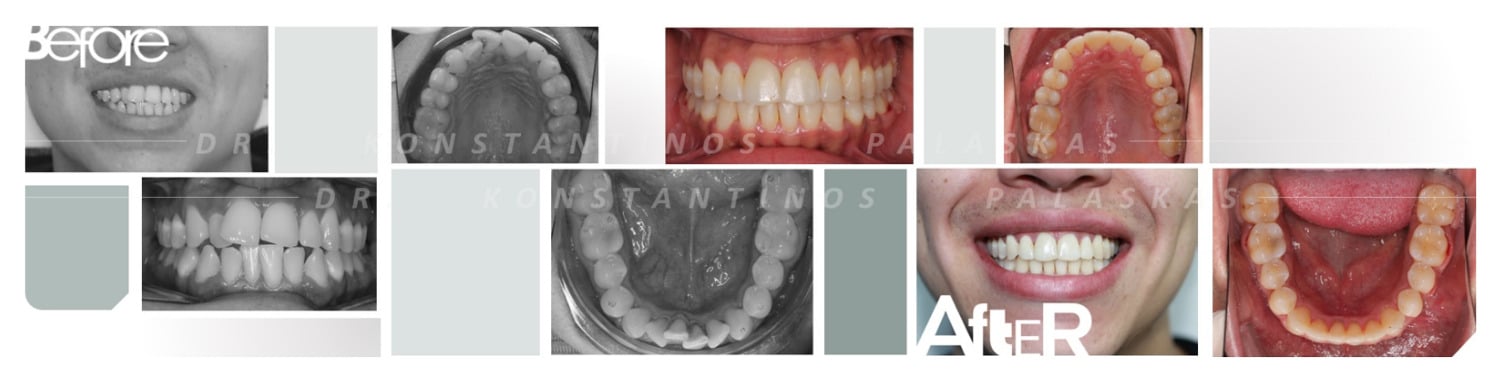 4 Apiñamiento Dental 0