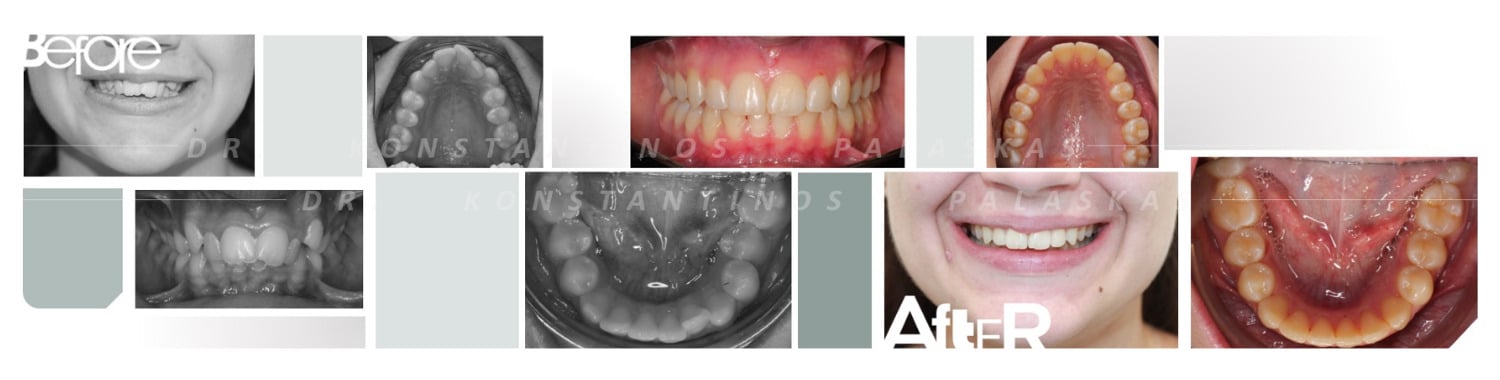 5 Apiñamiento Dental 0