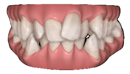Apiñamiento Dental Png