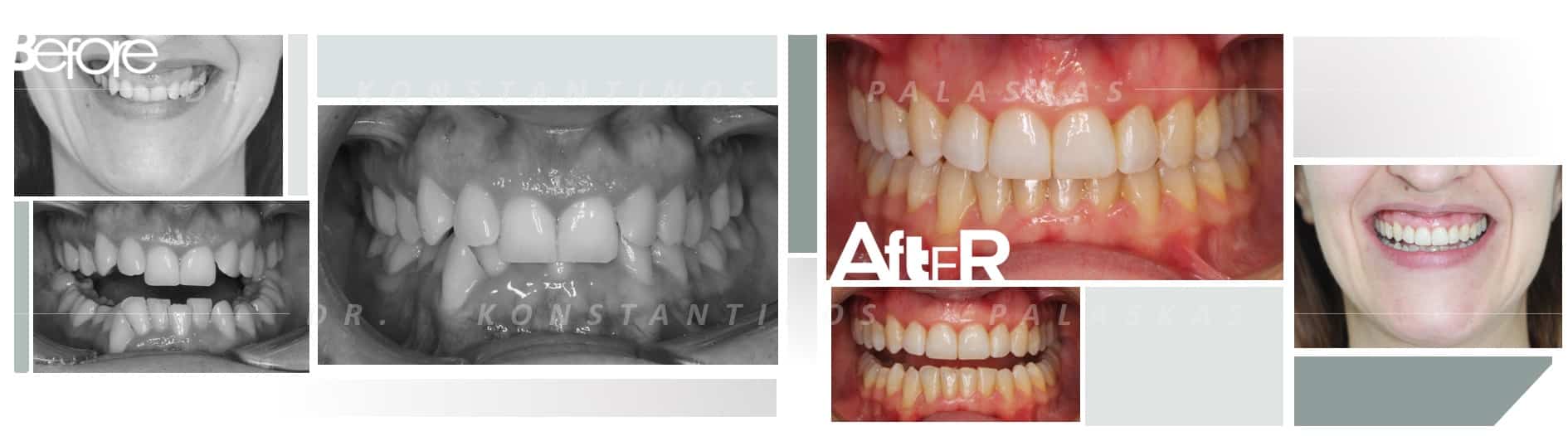 CASO 1 IRENE MORDIDA PROFUNDA