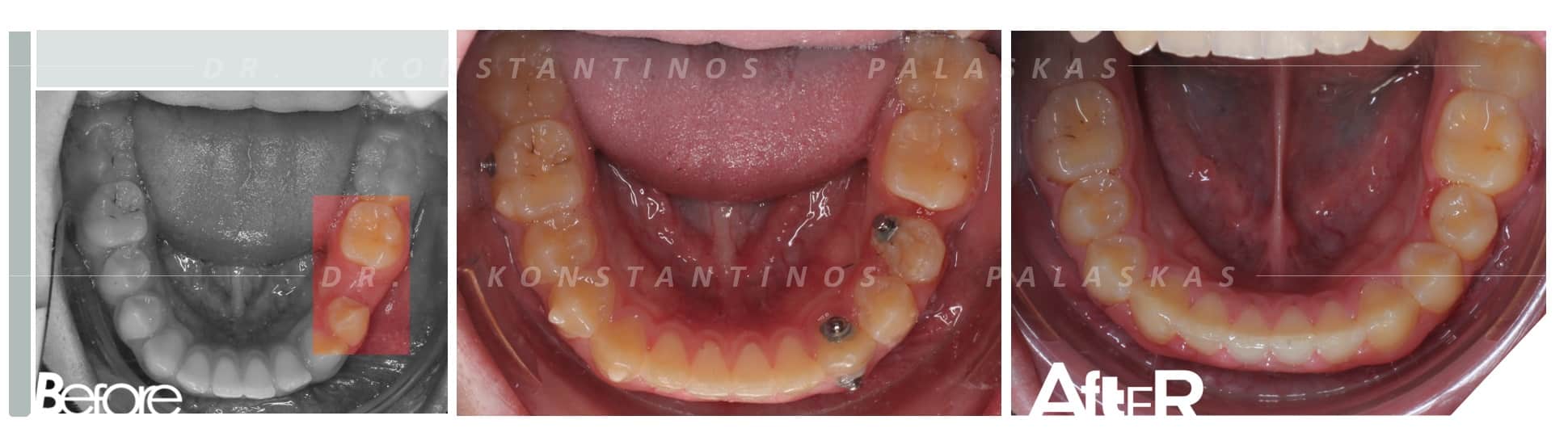 CASO 2 AFRICA PREMOLAR