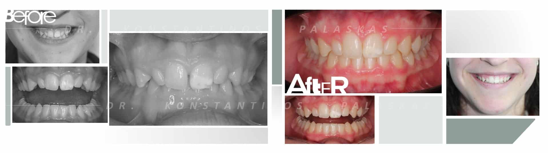 CASO 2 ALICIA MORDIDA PROFUNDA