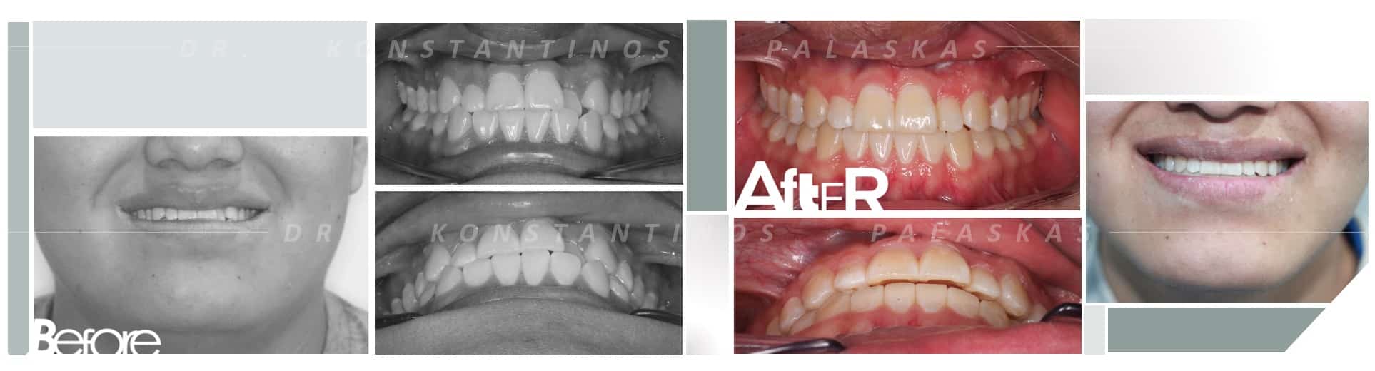 CASO 2 CRUZADA JOHNATAN
