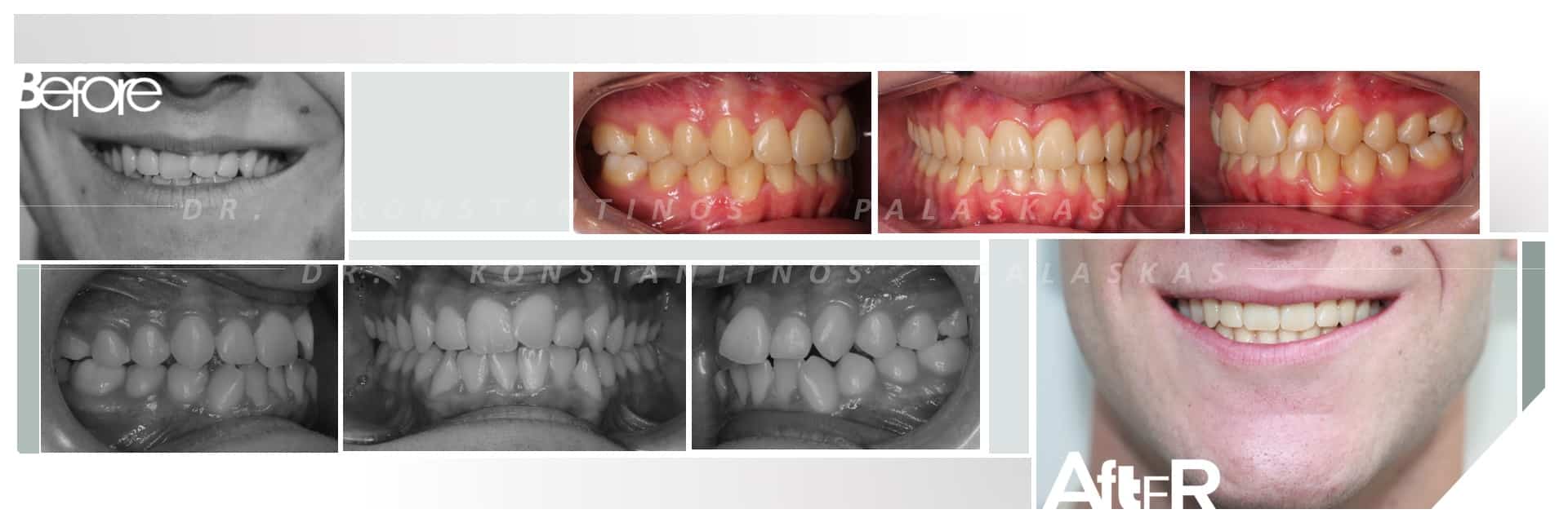 CASO 2 PELEGRINO CLASE III