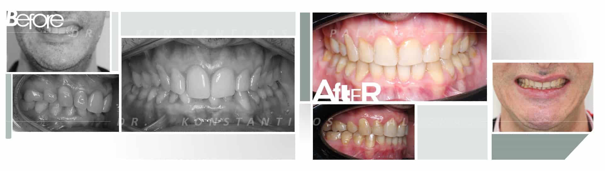 CASO 3 SAMUEL MORDIDA PROFUNDA