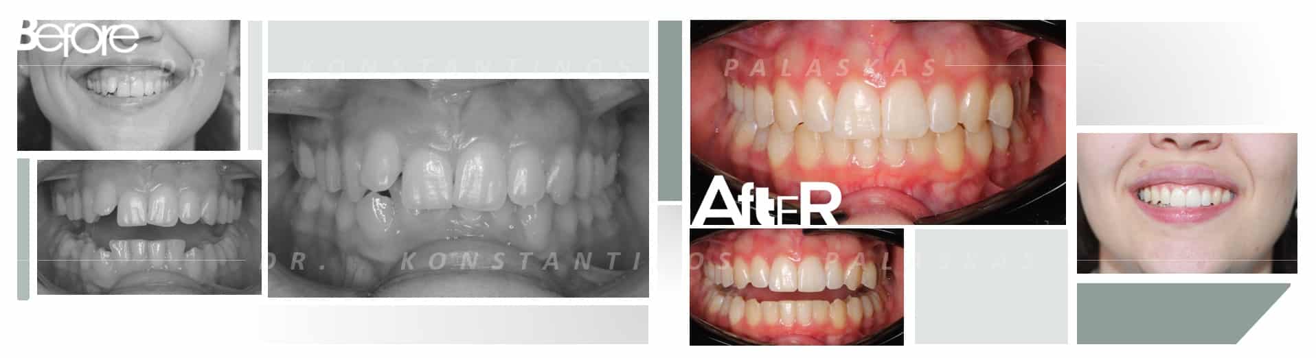 CASO 4 RAQUEL MORDIDA PROFUNDA